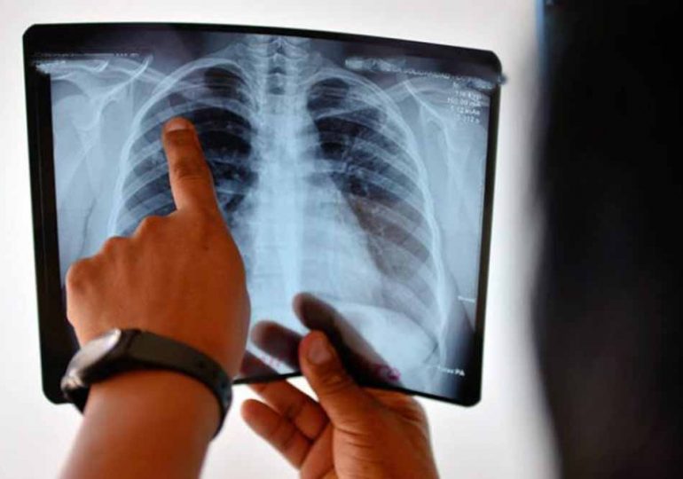 Preocupa el aumento de casos de tuberculosis en Maldonado