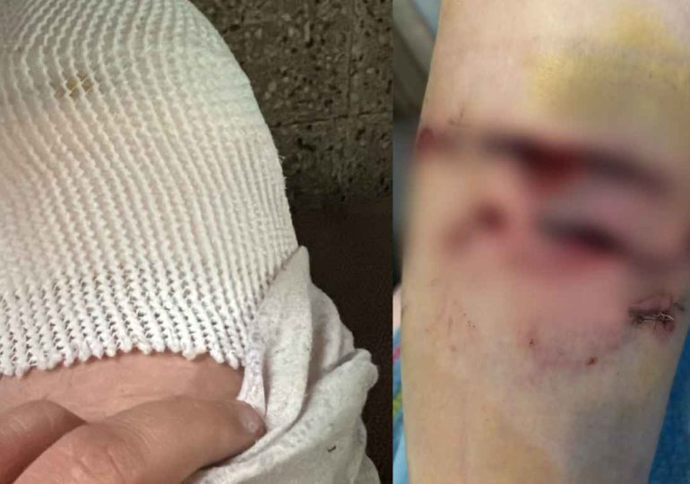 Una mujer sufrió graves lesiones tras ser atacada por dos perros en Pan de Azúcar